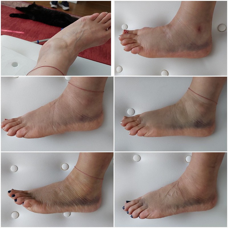 Progress photos of left ankle sprain